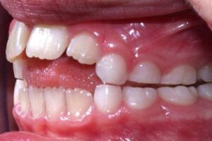 müofunktsionaalne teraapia aitab, kui luti imemise mõju hammastele